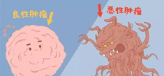 良性肿瘤与恶性肿瘤的区别